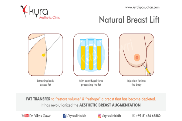 Breast Augmentation  - Fat Transfer