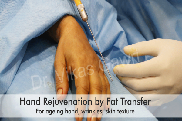 Fat Transfer to Hands