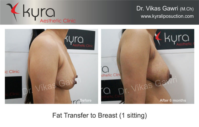 Fat Transfer To Breast In Ludhiana
