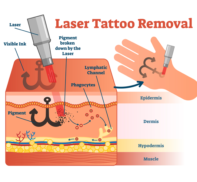 Laser Tattoo Removal Treatments in Ludhiana Punjab India