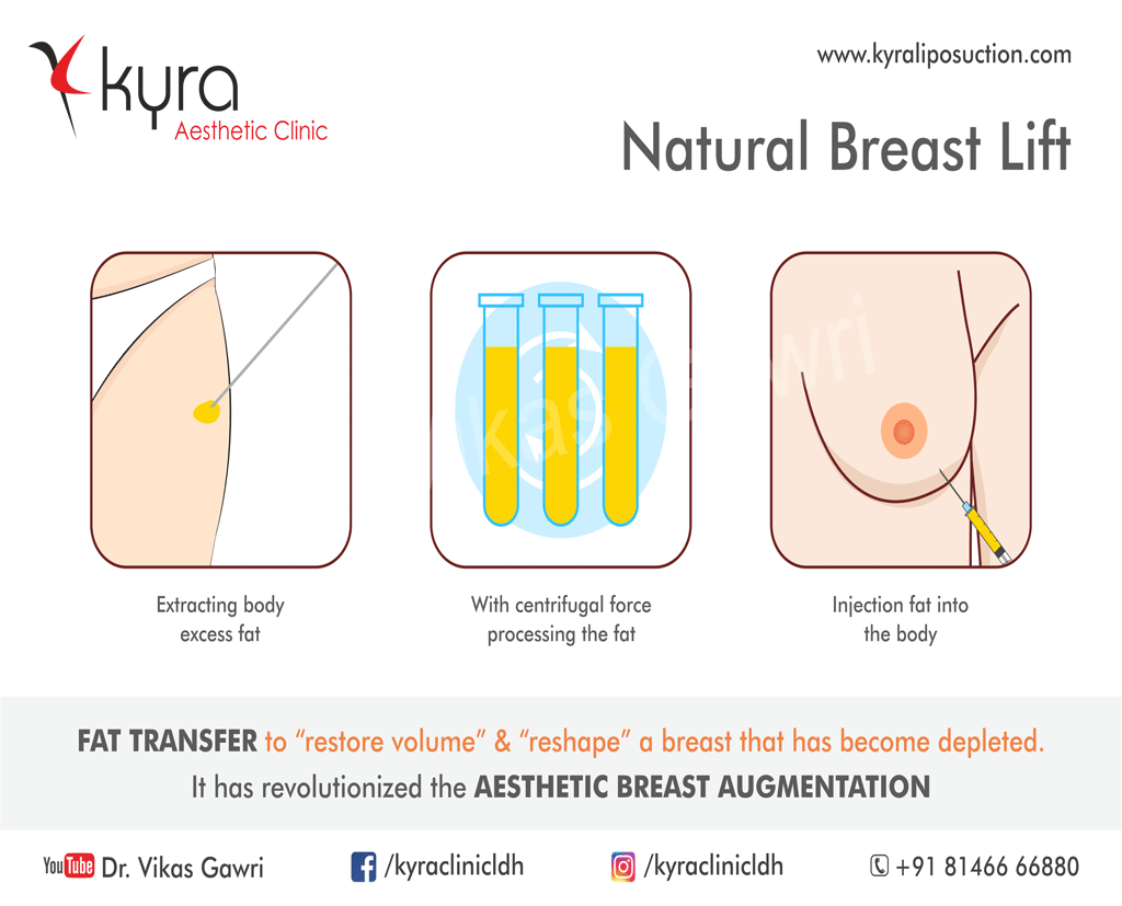 Breast implants vs fat transfer: which one should I go for?