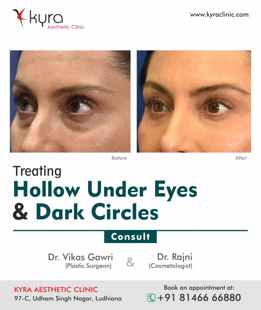Non Surgical Cosmetic Procedures To Treat Dark Circles Hollows And