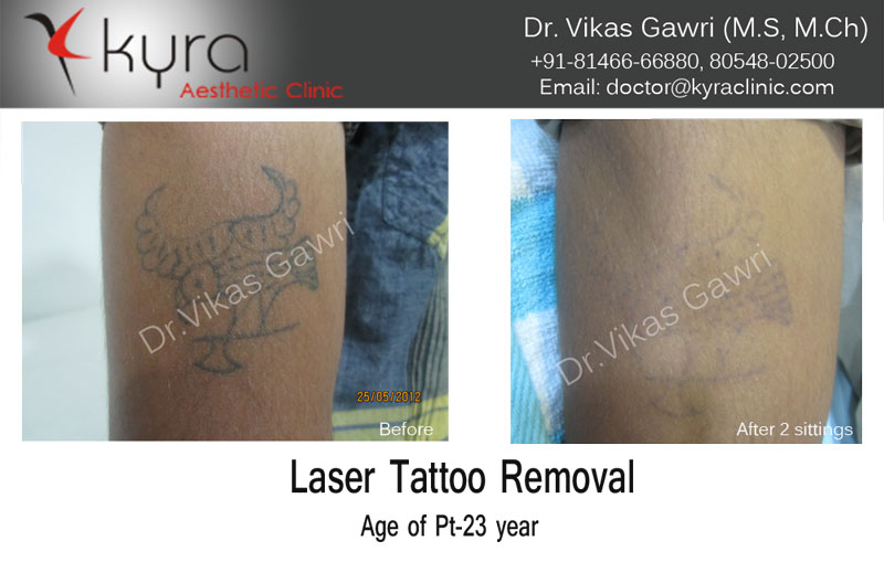 Yag Laser for Tattoo Removal Treatment Service at best price in Patiala