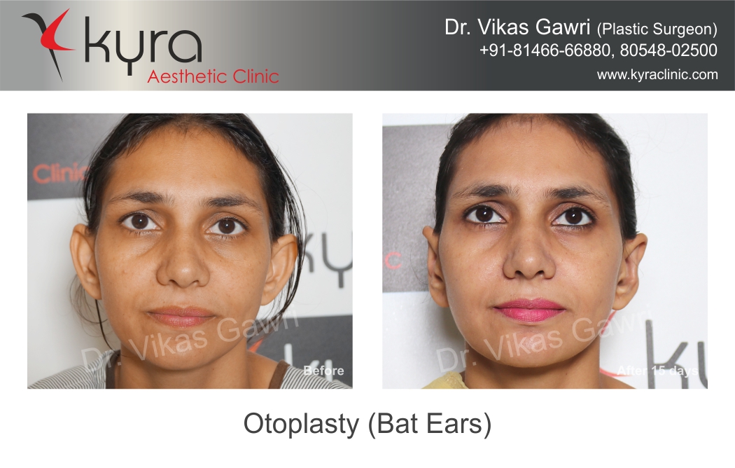 OTOPLASTY  JDT Plastic Surgery