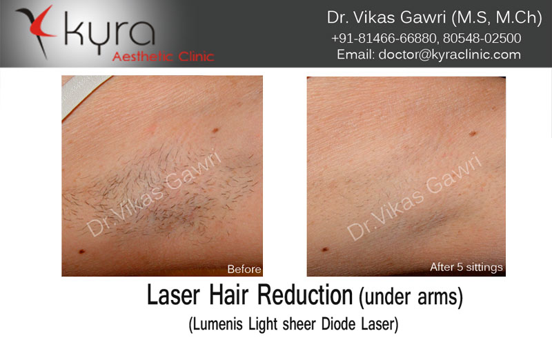 Adverse cutaneous events after laser epilation in patients with  photodermatosis  Indian Journal of Dermatology Venereology and Leprology