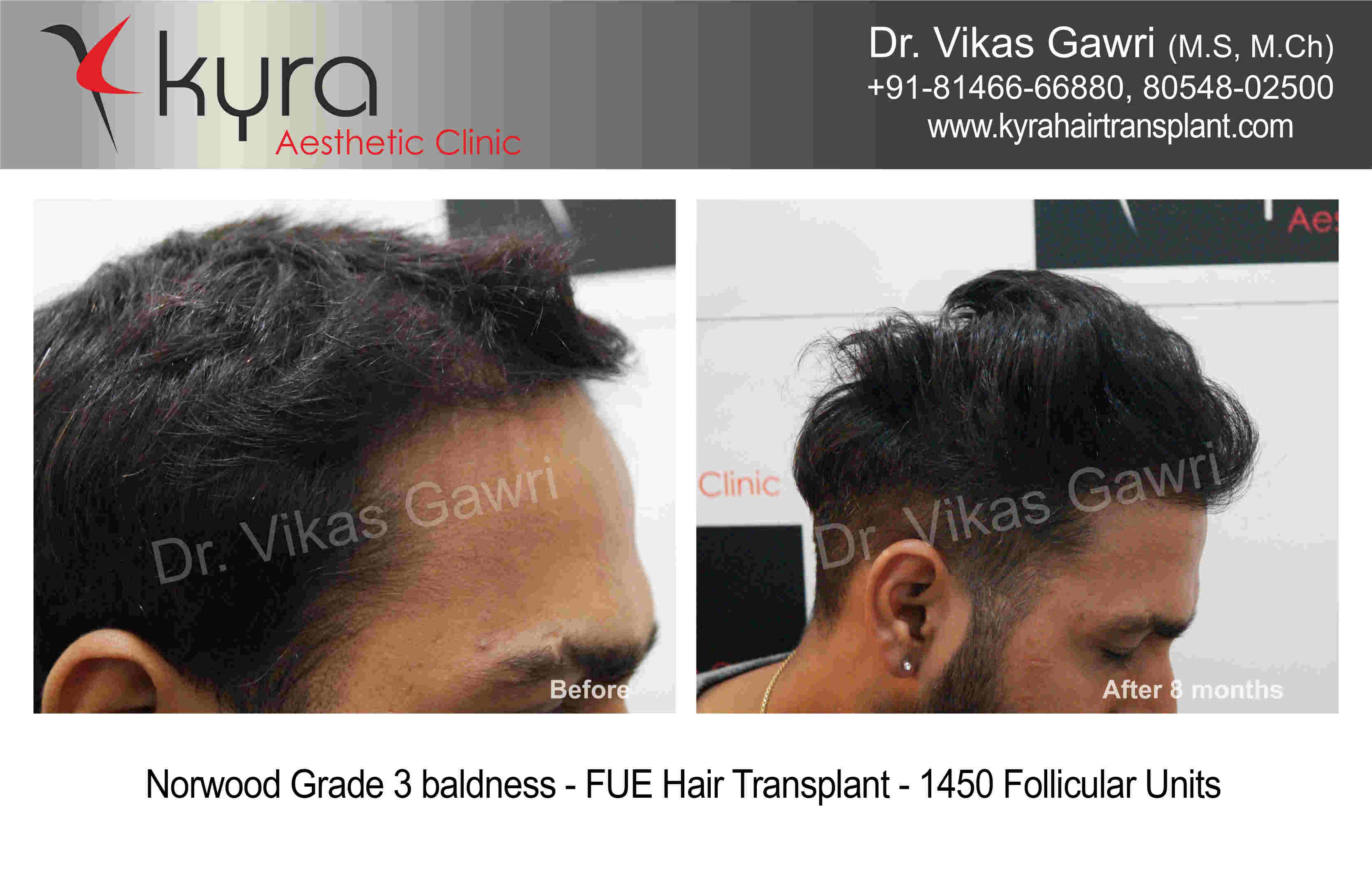 Hair Transplant In Pune  Eliminate Baldness