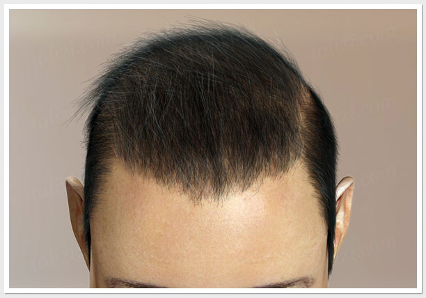 Body Hair Transplants of 10000 Grafts  Hair Loss Cure 2020