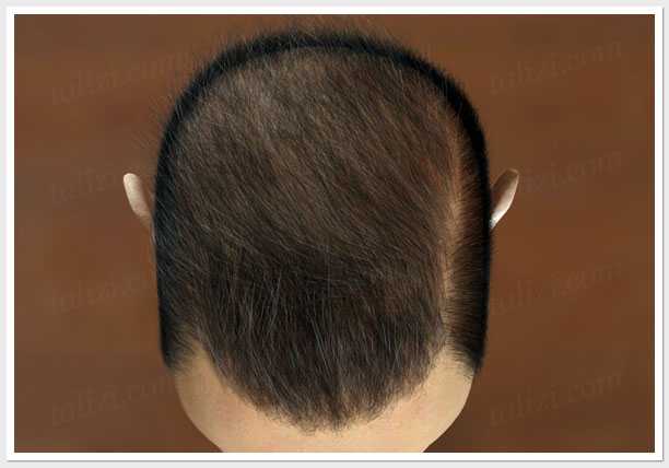 Hair Graft  Level VII  Cosmetic Surgery in Ludhiana Plastic Surgery in  Punjab Laser and Cosmetic Surgeon in Ludhiana Punjab India